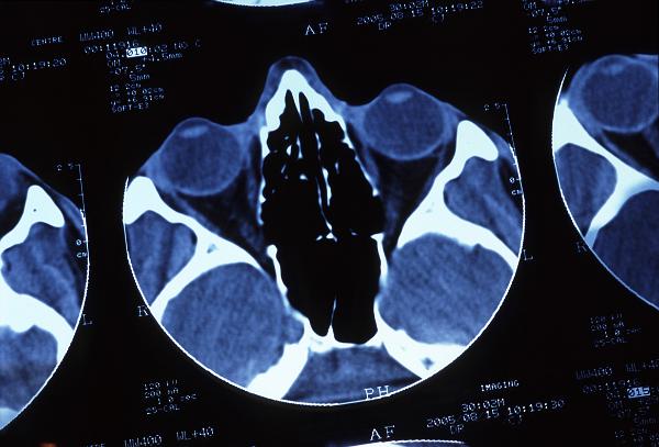 CT scan CT scan of a human head showing sections of the sinus and the eye balls (and lenses) to the top